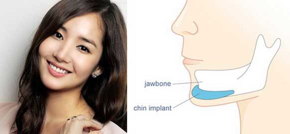 Nên gọt mặt hay độn cằm