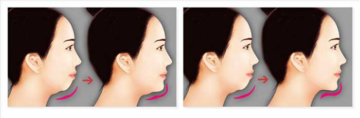 Độn cằm chữ V