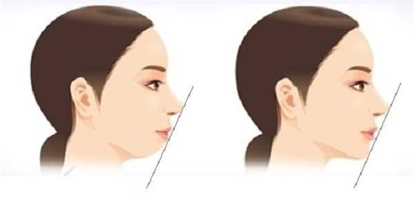 Độn cằm cho mặt tròn