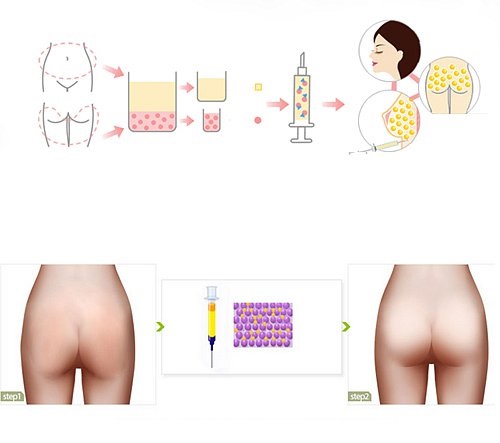 Chi phí nâng mông bằng mỡ tự thân