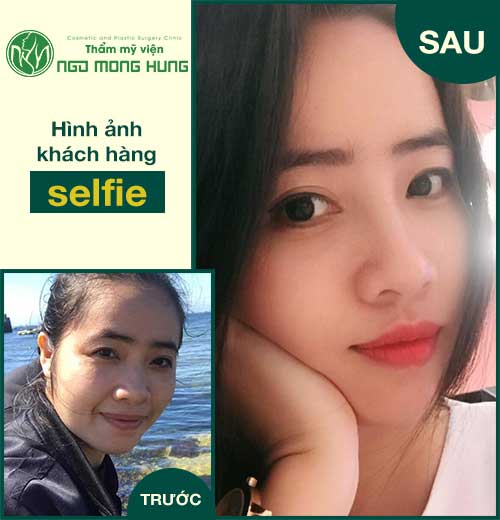 Thu nhỏ đầu mũi không cần phẫu thuật