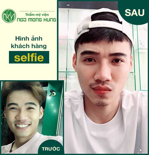 Phẫu thuật gương mặt cho nam giới