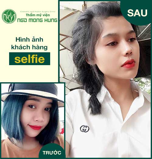 Thu nhỏ đầu mũi không cần phẫu thuật