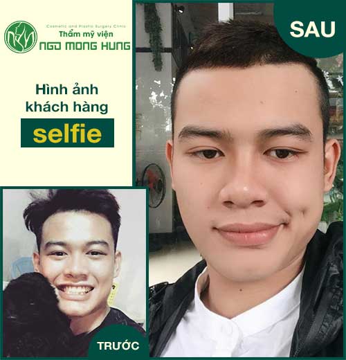 Phẫu thuật môi dày cho nam