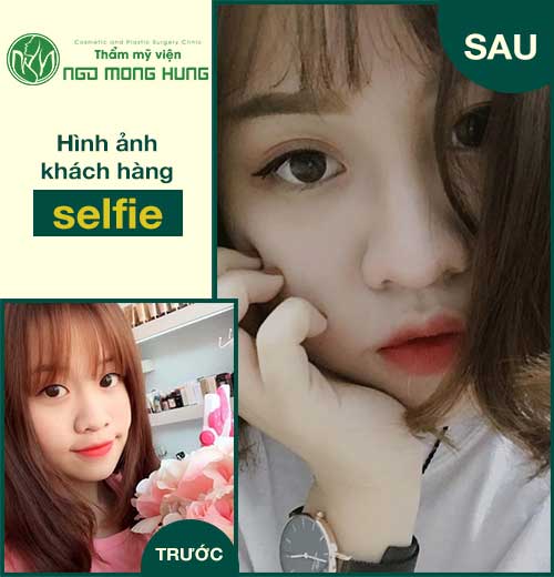 Thu nhỏ đầu mũi không cần phẫu thuật
