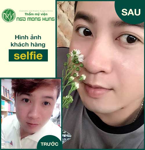 Phẫu thuật môi dày cho nam