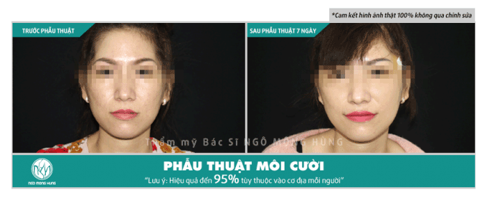 Phẫu thuật môi cười ở đâu