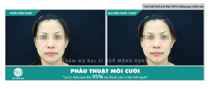Phẫu thuật tạo môi cười