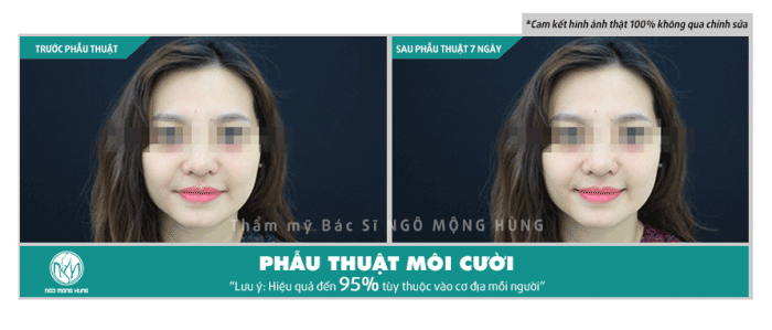 Phẫu thuật làm môi chẻ