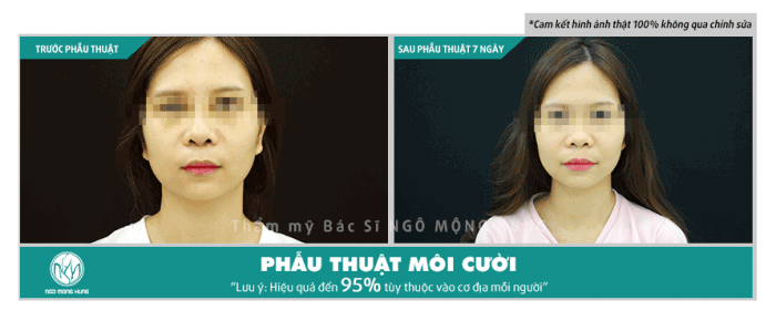 Phẫu thuật tạo môi cười