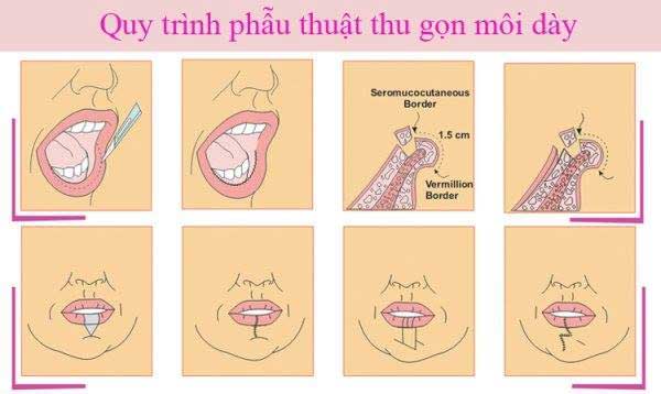 Phẫu thuật thẩm mỹ làm mỏng môi