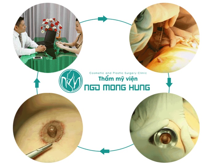 Thu nhỏ quầng thâm vú