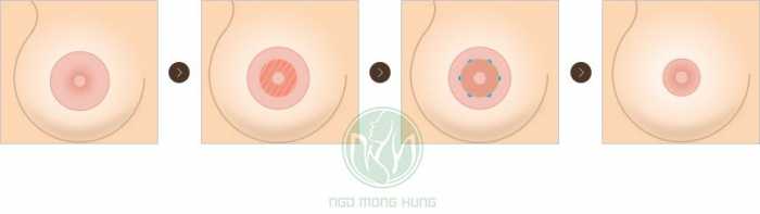 Làm sao để thu nhỏ quầng vú