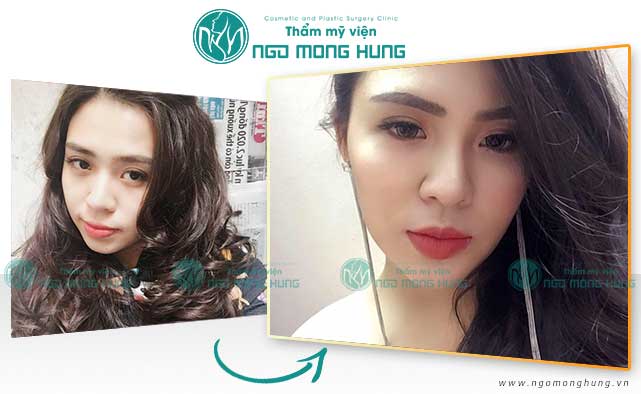 Phẫu thuật toàn bộ khuôn mặt