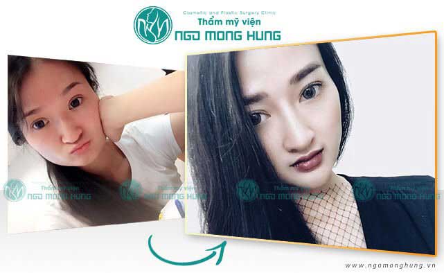 Phẫu thuật toàn bộ khuôn mặt