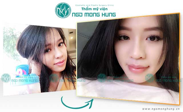Phẫu thuật thu mỏng môi