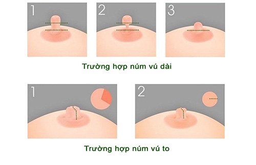 Thu nhỏ quầng vú giá bao nhiêu