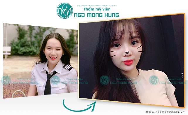 Thẩm mỹ mở rộng góc mắt ngoài