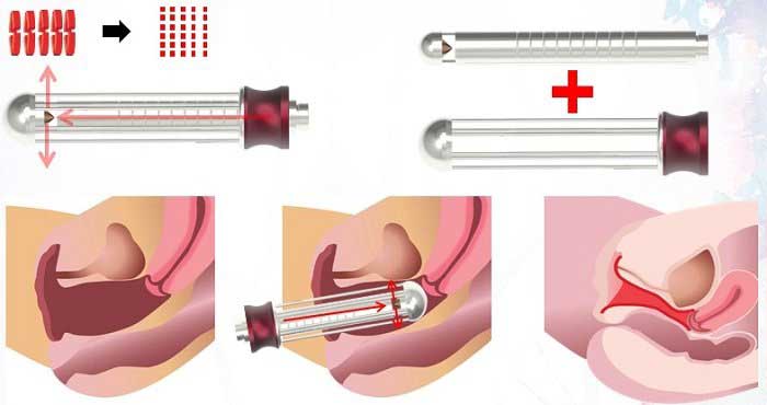 Tạo hình thẩm mỹ vùng kín