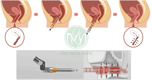 Thẩm mỹ vùng kín ở đâu tốt nhất
