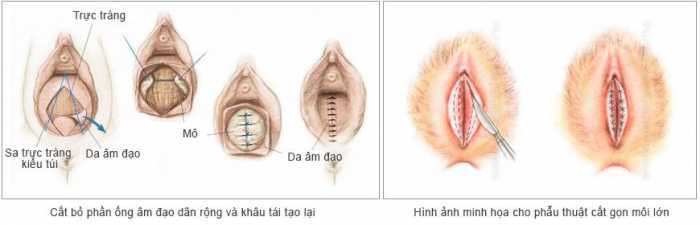 Chi phí thu hẹp tầng sinh môn