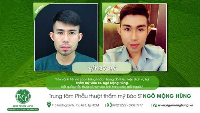 Lấy mỡ má