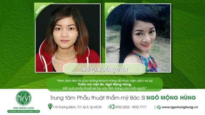 Má lúm đồng tiền