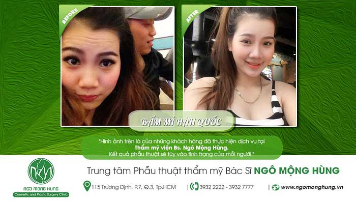 Bấm mí Hàn Quốc