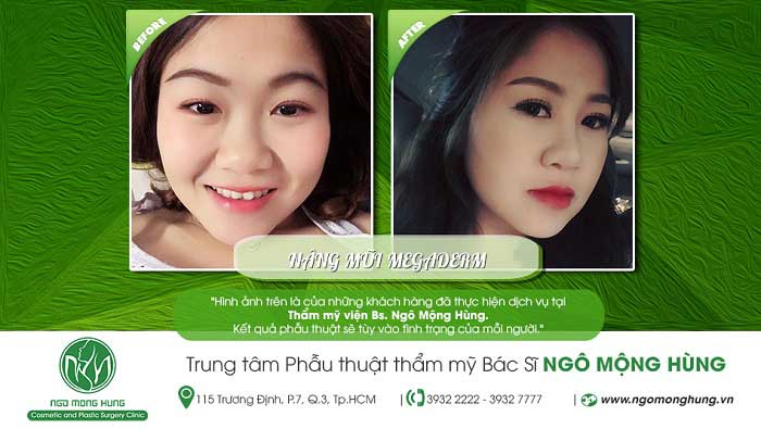 Nâng mũi bọc sụn