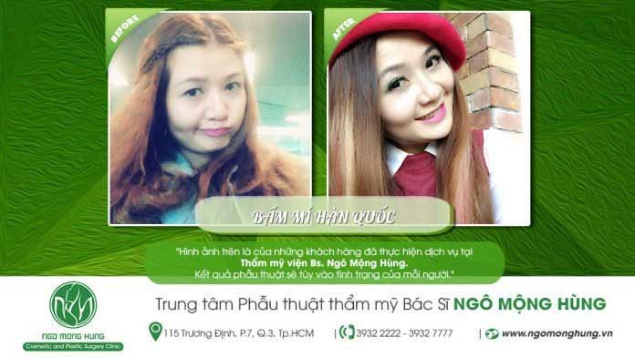 Bấm mí Hàn Quốc Bấm mí Hàn Quốc