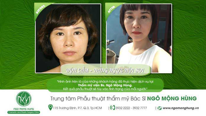 Độn cằm