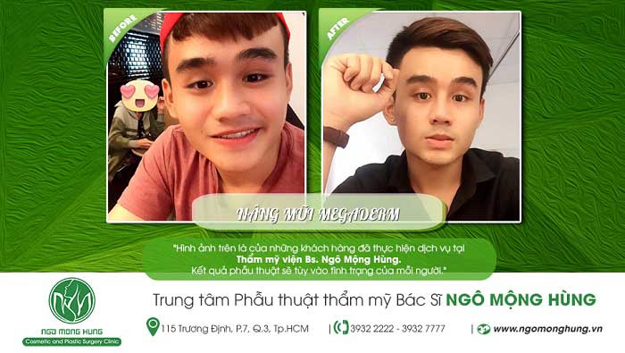 Nâng mũi bọc sụn