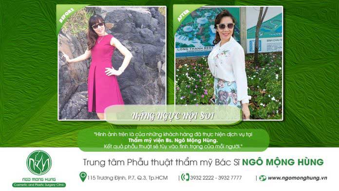 Nâng ngực nội soi