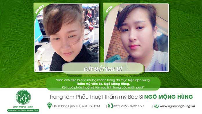 Cắt mí mắt