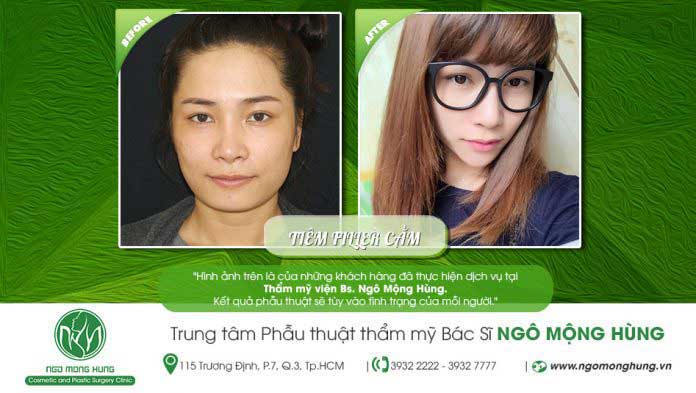Độn cằm