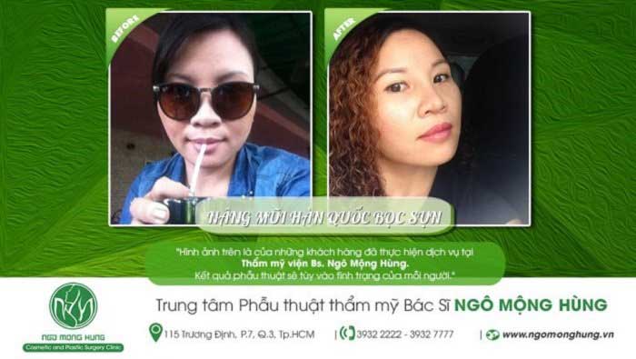 Nâng mũi bọc sụn