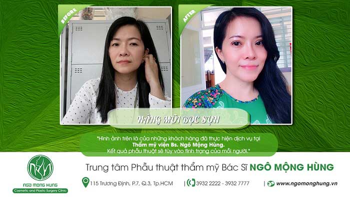 Nâng mũi bọc sụn Nâng mũi bọc sụn