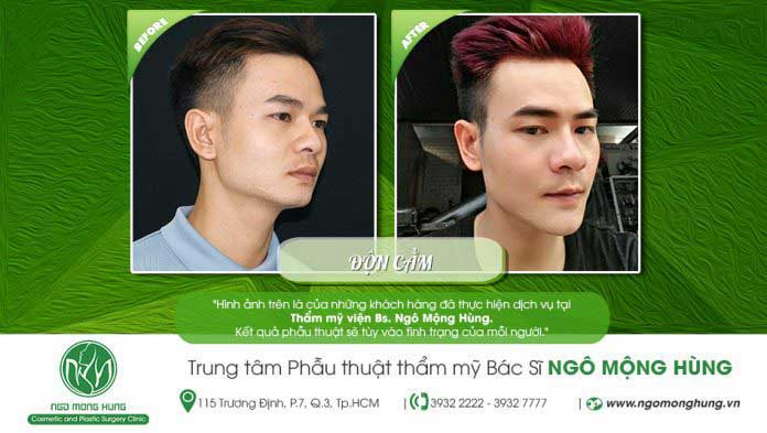 Độn cằm