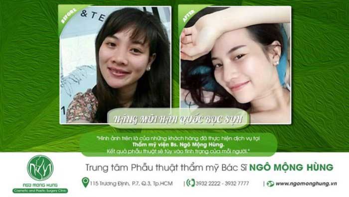 Nâng mũi bọc sụn