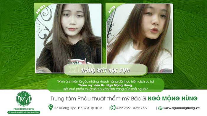 Nâng mũi bọc sụn