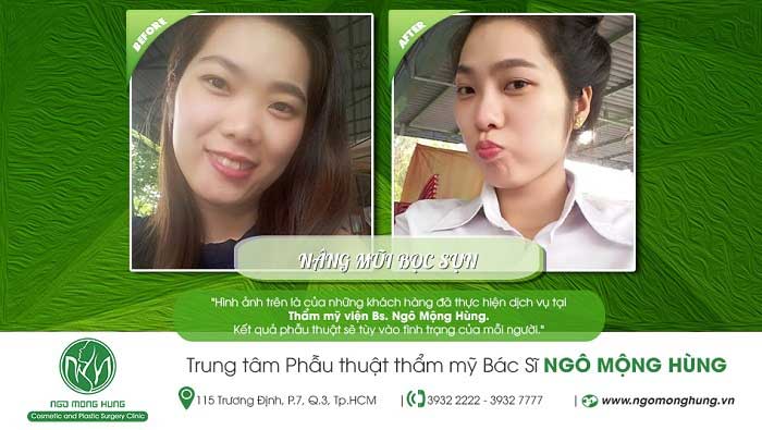 Nâng mũi bọc sụn