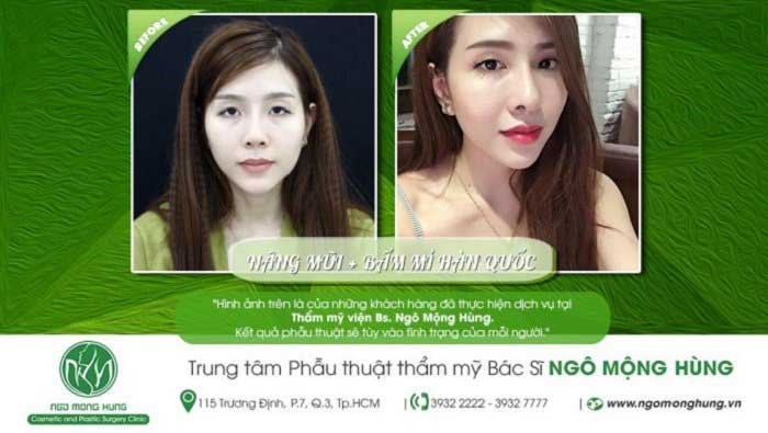 Nâng mũi Hàn Quốc