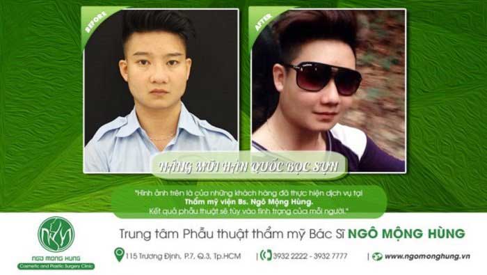 Nâng mũi bọc sụn