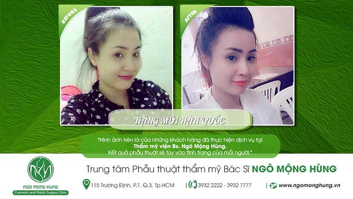 Nâng mũi Hàn Quốc
