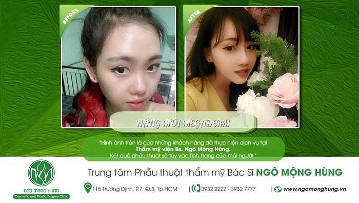Nâng mũi bọc sụn