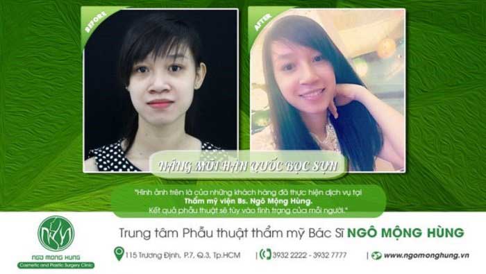 Nâng mũi bọc sụn