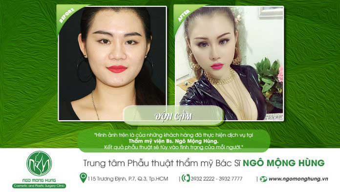 Độn cằm