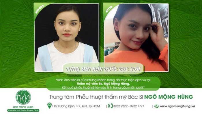 Nâng mũi bọc sụn