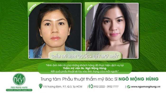 Lấy mỡ má