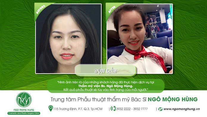 Độn cằm